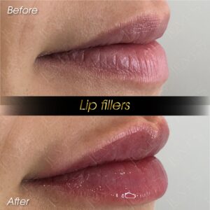 Natural-looking full lips after hyaluronic acid filler treatment