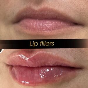 Lip transformation using 1ml of Juvederm filler