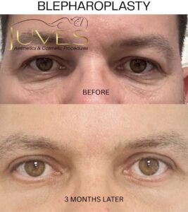 blepharoplasty-before-after-orlando