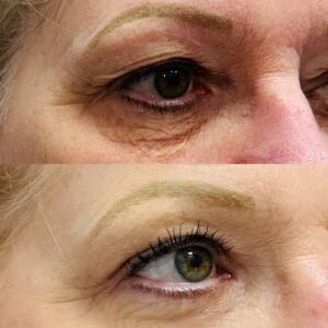 blepharoplasty-before-after-orlando