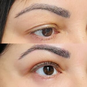 blepharoplasty-before-after-orlando