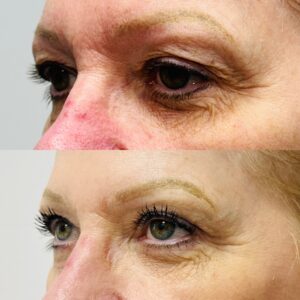 blepharoplasty-before-after-orlando