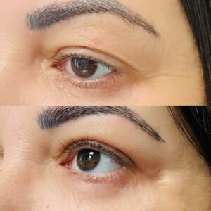 blepharoplasty-before-after-orlando